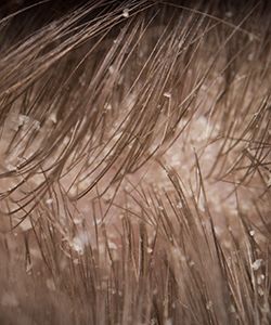 6 Easy Remedies to Control Your Winter Dandruff