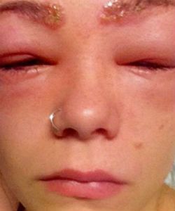 How to Prevent a Severe Allergic Reaction to Permanent Hair Color