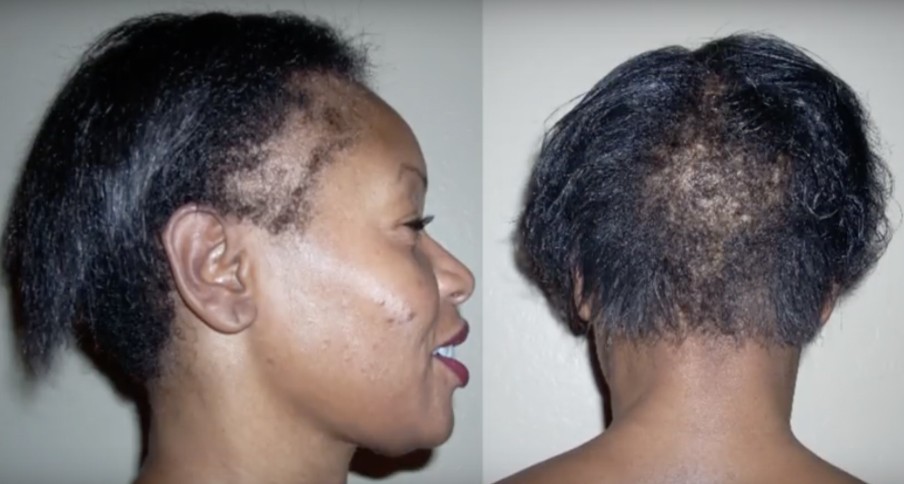 HairLoss700x375